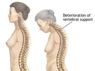Shrinking, Losing Height as a result of Osteoporosis